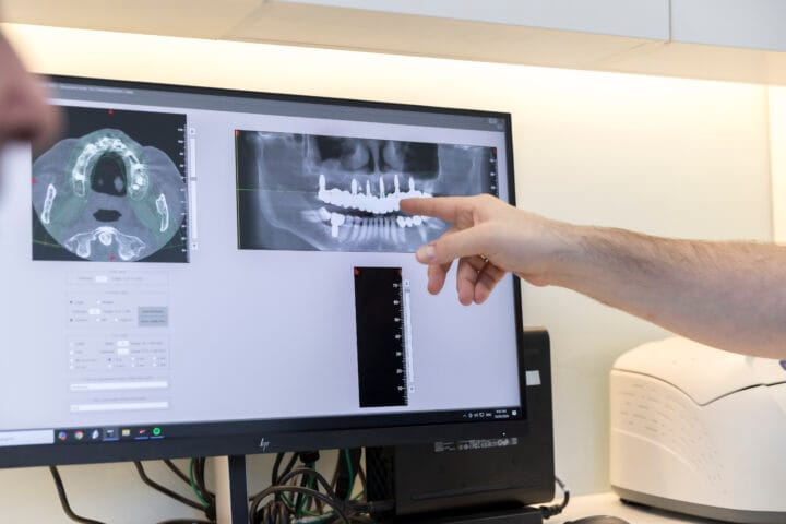 implant planning