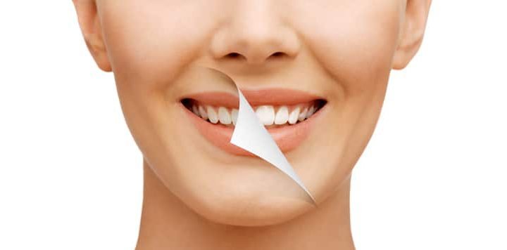 Tooth whitening difference
