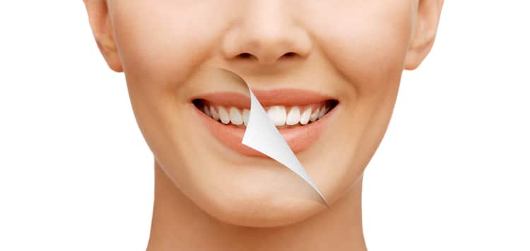 Tooth whitening difference