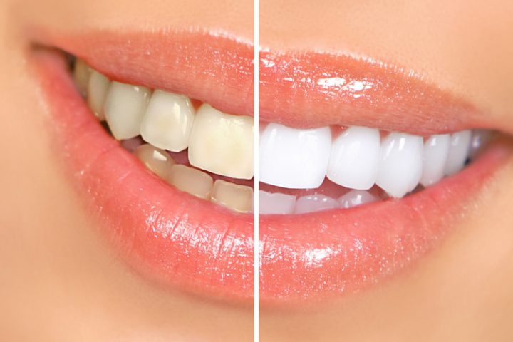 Before and after teeth whitening