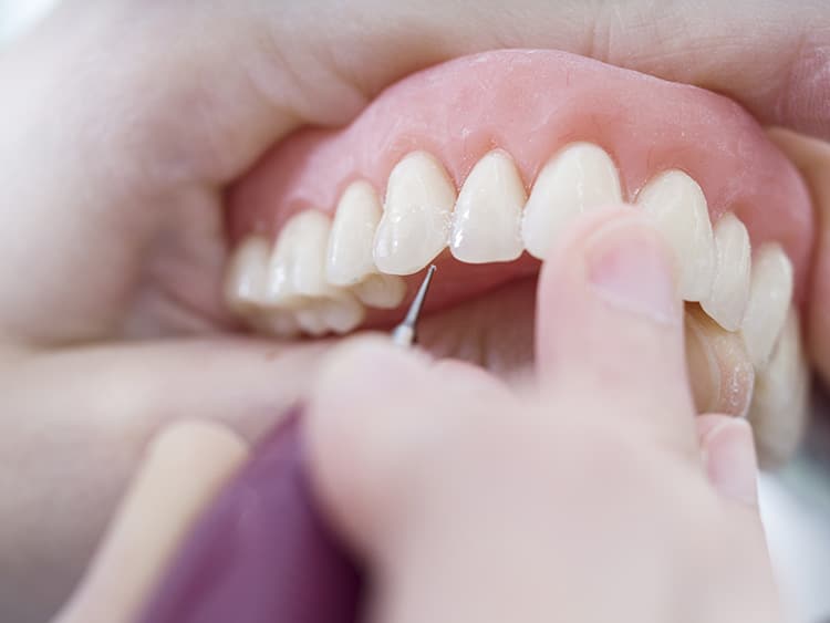 False teeth zirconia implants