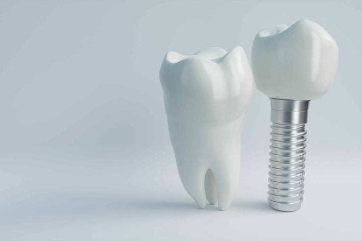 Human and Implant Tooth Models